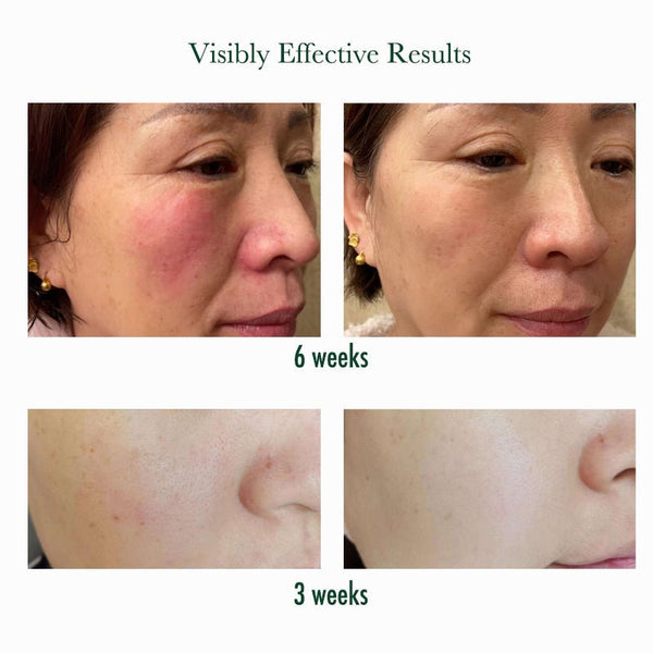 Visibly effect of Vitamin B5 barrier repair Cream-before and after